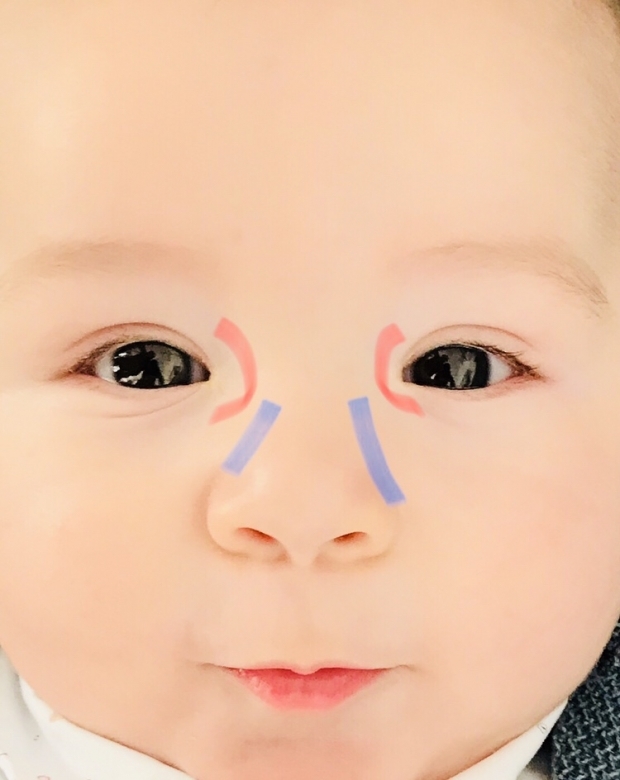 Ögonborrmassage hos spädbarn