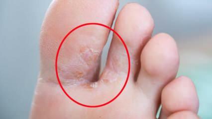 Vad är fot svamp? Vilka är symtomen på fotsvamp? Finns det ett botemedel mot idrottsman fot?