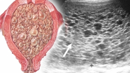 Vad är moll graviditet (grape graviditet), vilka är symptomen? Hur förstår man graviditet i mullvadagen?