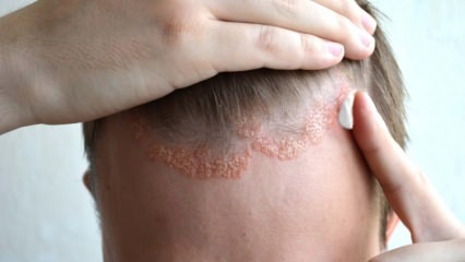 Vilka är symtomen på seborrheic dermatit och vem visas det? Livsmedel som utlöser sjukdomen