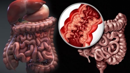 Vad är Crohns sjukdom? Vilka är symtomen på Crohns sjukdom? Finns det ett botemedel mot Crohn?