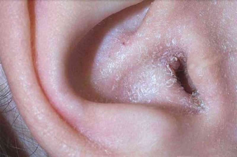 Vad orsakar skalning bakom örat och hur passerar det? Den slutgiltiga lösningen för eksem bakom örat ...