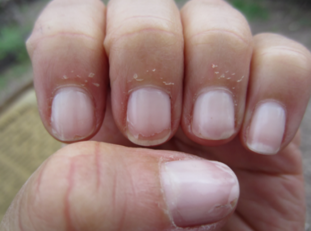 Vad är orsakerna till nagelbensskalning, hur behandlas det?