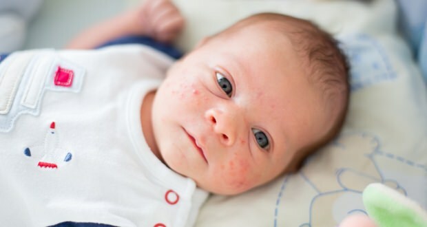 Varför förekommer akne hos spädbarn?
