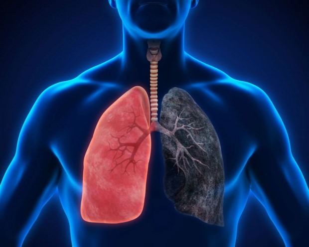 vad är lungcancer