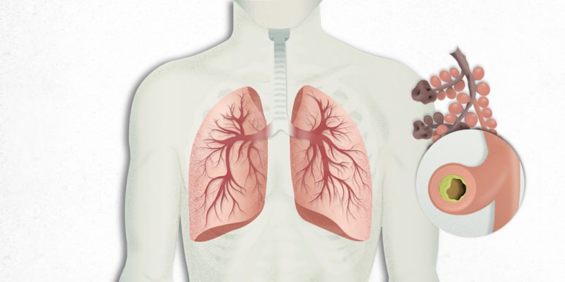 viruset som sätter sig i lungorna blandas med lunginflammation