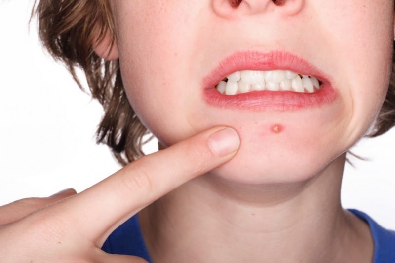 Varför gör acne utbrott på hakan Naturlig lösning för käkeakne