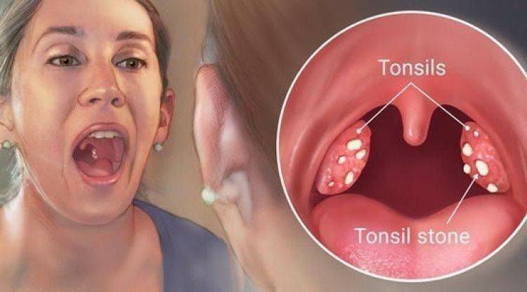 tonsilitis kallas svullnad i mandlarna