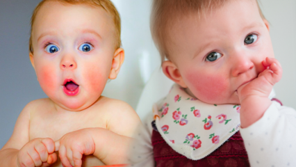 Uppmärksamhet hos spädbarn med röda kinder! Slappt kindsyndrom och dess symtom