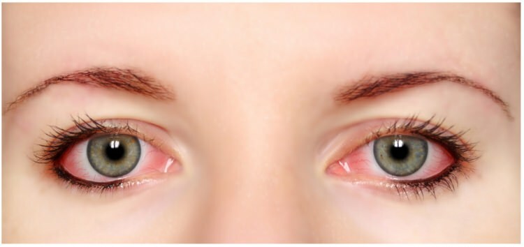 Har mascara och eyeliner allergi i ögonen?