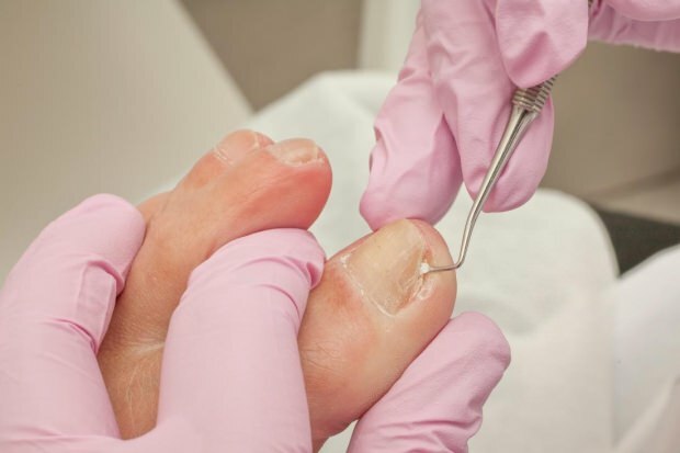 Vad orsakar ingrodda tånaglar och vilka är symtomen? Naturliga sätt som är bra för ingrodda naglar ...