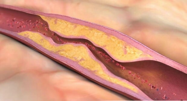 Vad orsakar ateroskleros? Hur många typer av vaskulär ocklusion finns det?