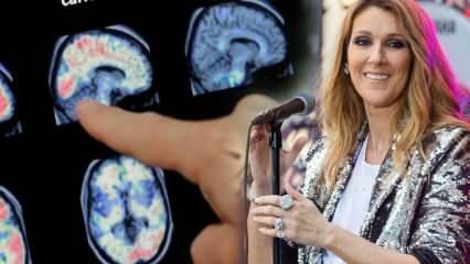 Vad är stiff-person syndrome? Celine Dion