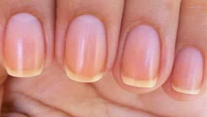 Varför blir naglarna gula? Den enklaste metoden att bleka naglar som gulnat med nagellack