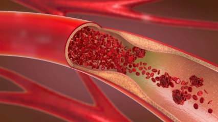 Vad är anemi (anemi)? Vilka är symptomen på anemi? Livsmedel som är bra för anemi ...
