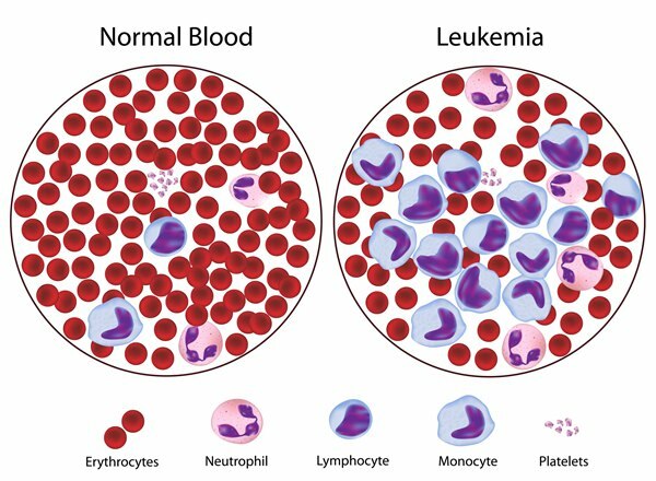 vad är leukemi
