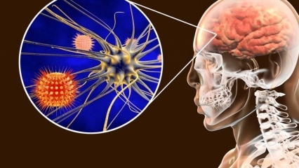 Vad är hjärnhinneinflammation och vilka är symptomen? Finns det en behandling för meningit?