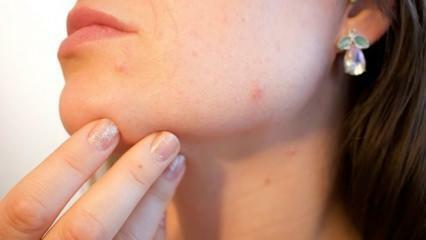 Vad är hudcancer (melanom)? Vilka är symtomen på melanom och finns det ett botemedel?