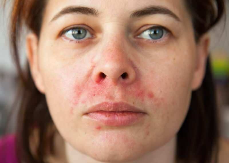 Varför visas akne runt läppen? Hur behandlas perioral dermatit?