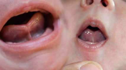 Vad är tungbindningen (Ankyloglossi) hos spädbarn? Tungbindningssymtom och behandling ...