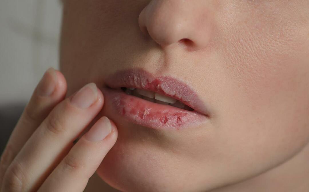 Vad orsakar mörka läppar? Hur behandlas mörkare läppar eller blåmärken?