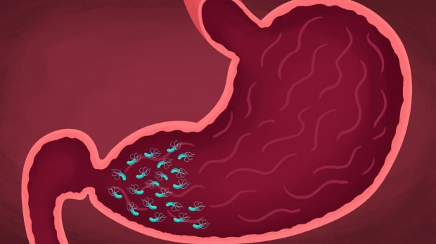 vissa virus och bakterier kan orsaka gastrit
