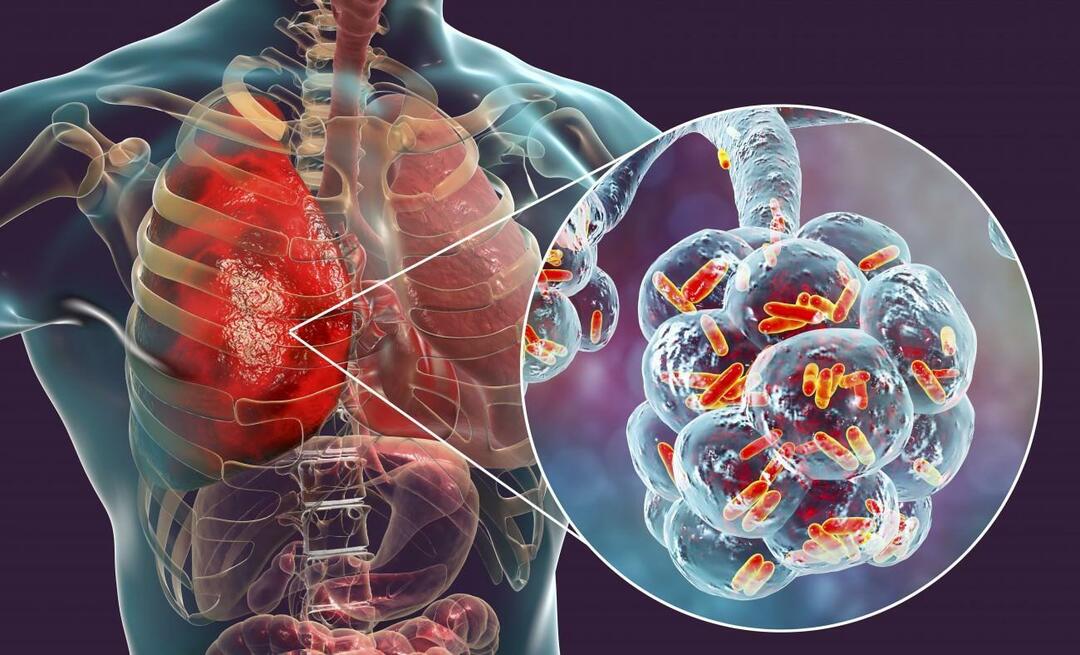 Vad är lunginflammation och vilka är dess symtom? Hur behandlas den nya epidemin Pneumonivirus?