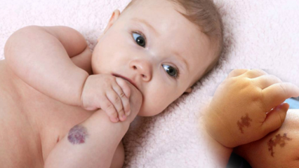 Orsakar födelsemärke hos spädbarn, är det permanent? Vilka typer av födelsemärken? Bot från Saracoglu
