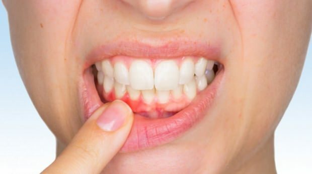 Vanliga tandköttsproblem