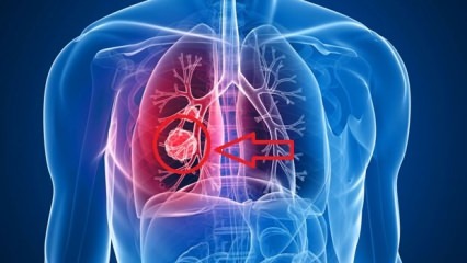 Symtom på lungcancer: stadier av lungcancer!