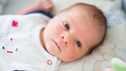 Hur går akne i barnets ansikte? Acne (Milia) torkningsmetoder