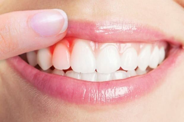 Vad orsakar blödning i tandköttet?