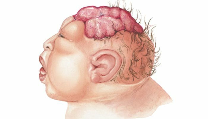 Vad är Anencephaly? Vilka är symptomen på anencefali hos spädbarn och barn? Anencefali orsakar ...