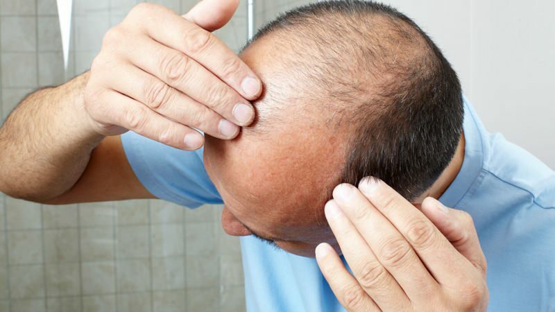 Förhindrar hårtransplantation ghusl?