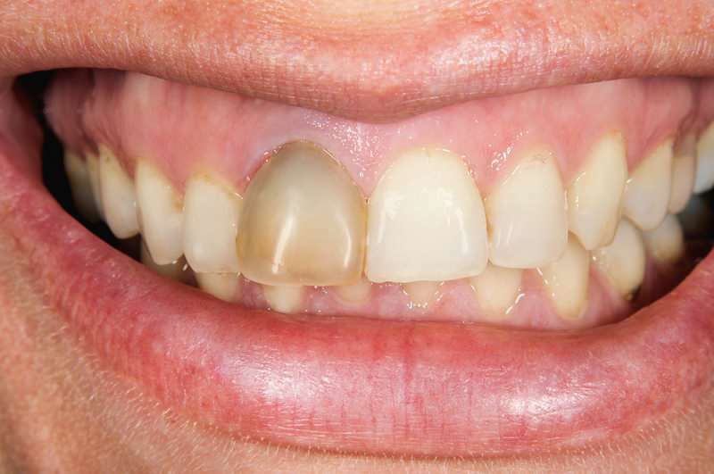 tänder mörkare kan ibland koncentrera sig på en tand