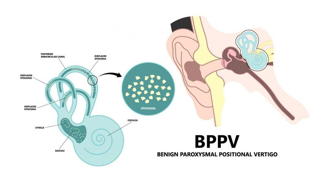 Varför snurrar huvudet när man ligger ner? Vad är bra för Benign Paroxysmal Positional Vertigo? Hur man blir av med BPPV