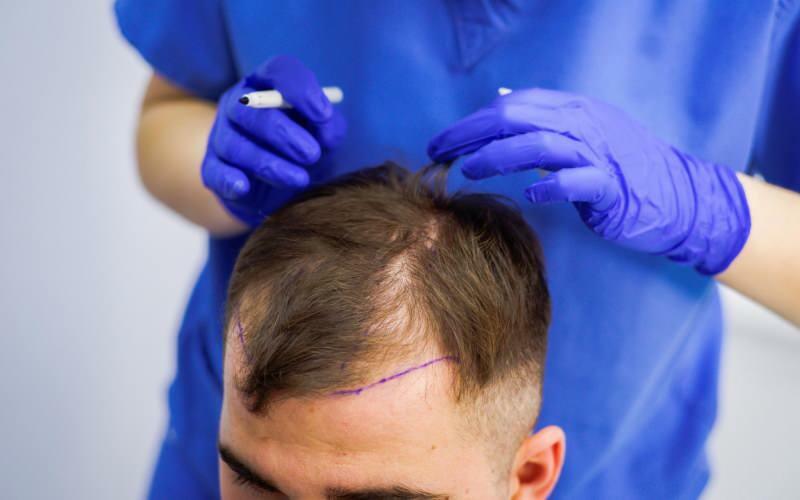Är det tillåtet att transplantera hår vid behandling av håravfall? Vad är protetiskt hår? Hindrar protetiskt hår ghusl?