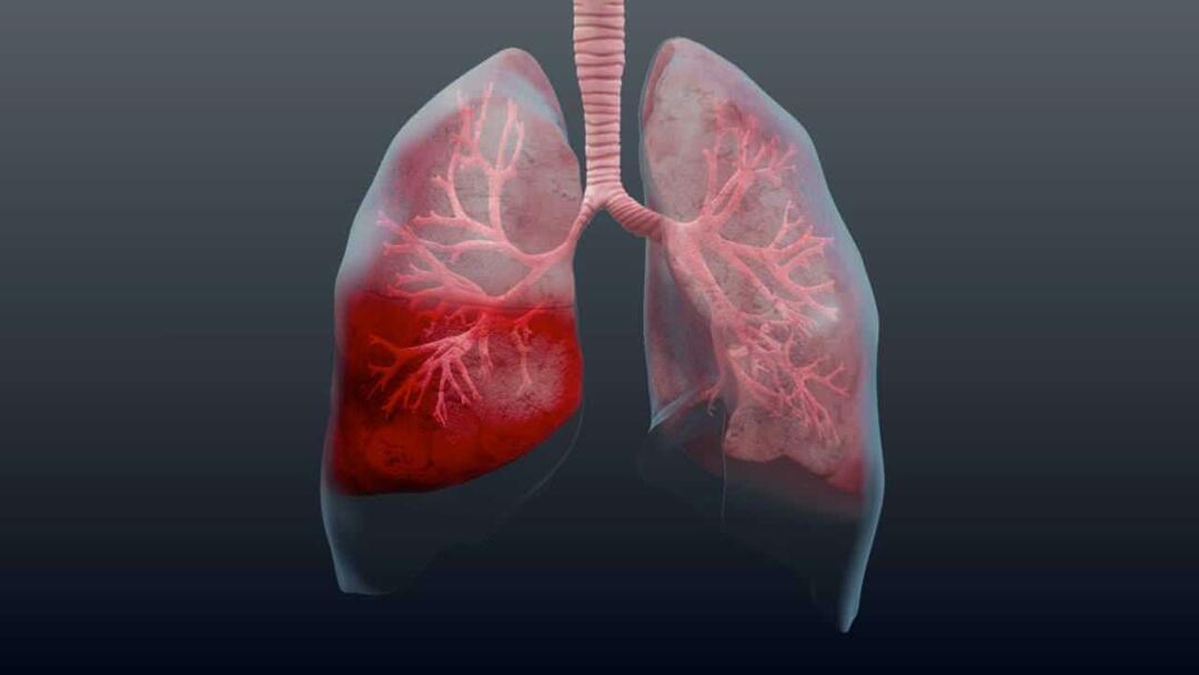 Vad är lunginflammation och vilka är dess symtom? Hur behandlas den nya epidemin Pneumonivirus?