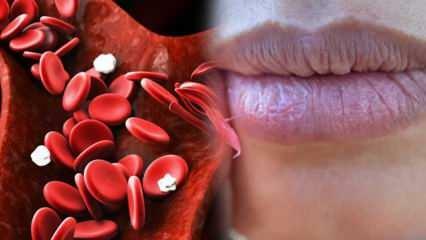 Vad är anemi? Konstant svaghet är ett tecken på anemi! Livsmedel som är bra för anemi ...