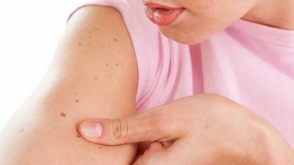 Vad är hudcancer och vilka är dess symtom? Sätt att förstå hudcancer