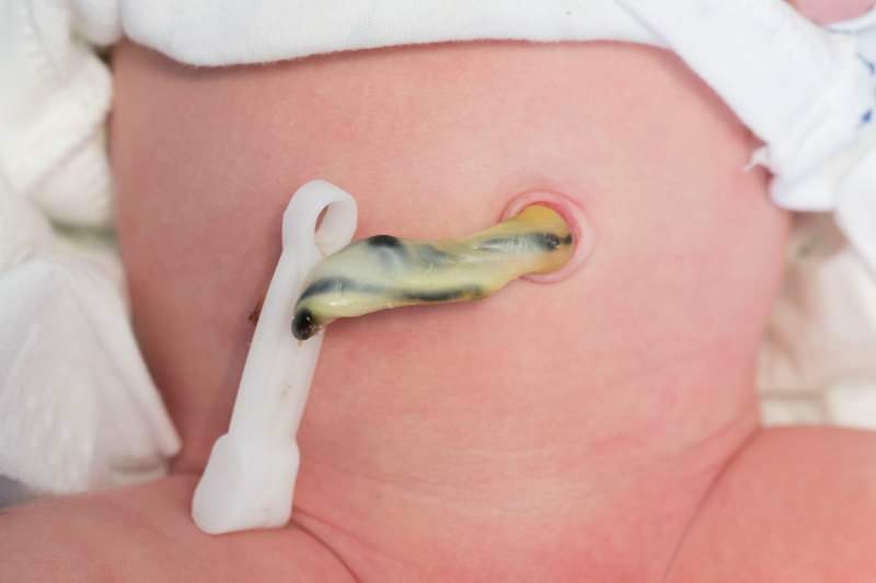 När skärs navelsträngen hos spädbarn? Fördelar med att klippa navelsträngen sent