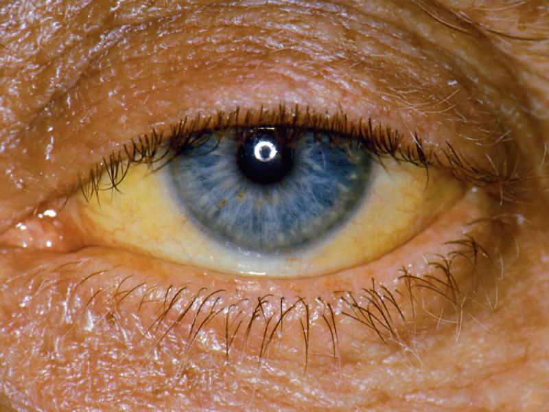 höjd på bilirubinnivå orsakar gul färg på ögon och hud