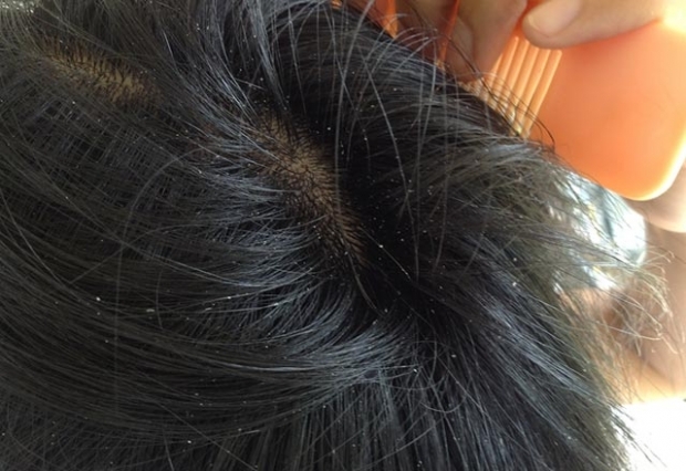 Varför akne i hårbotten