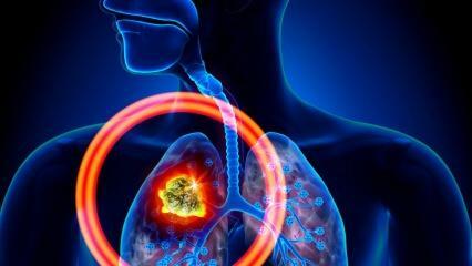 Vilka är symptomen på lungcancer? Finns det någon behandling för lungcancer?