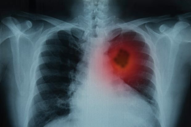 Vilka är symptomen på lungcancer? Finns det en lungcancerbehandling? För att förhindra lungcancer ...