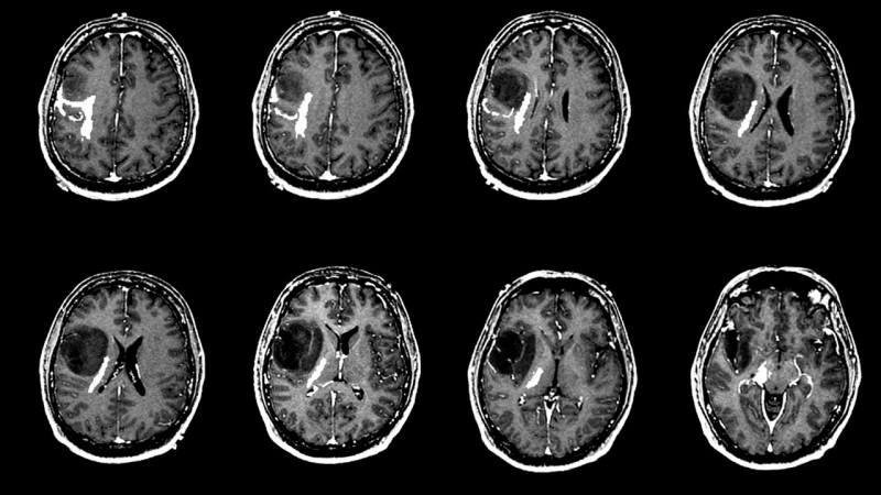 Vad orsakar hjärntumör? Vilka är symtomen på hjärntumör? Är hjärntumörbehandling svår?