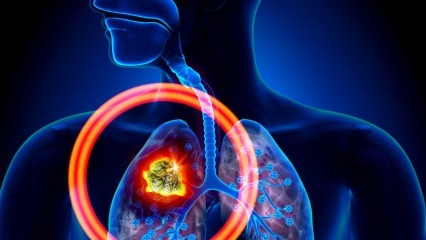 Vilka är symptomen på lungcancer? Finns det en lungcancerbehandling? För att förhindra lungcancer ...