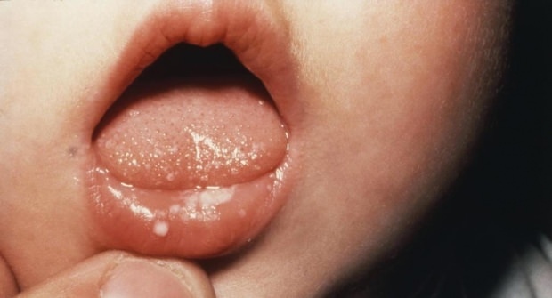Hur gör ont i munnen hos spädbarn