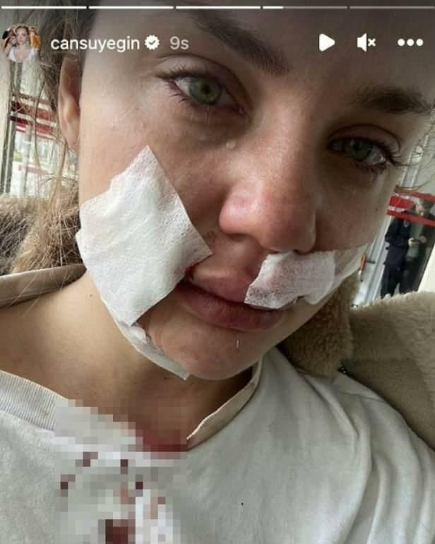 Cansu Yeğin attackerades av en hund