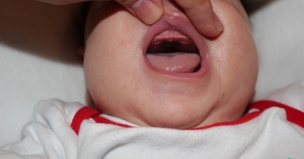 Vad är gommen droppe hos spädbarn, varför? Symtom och behandling ...